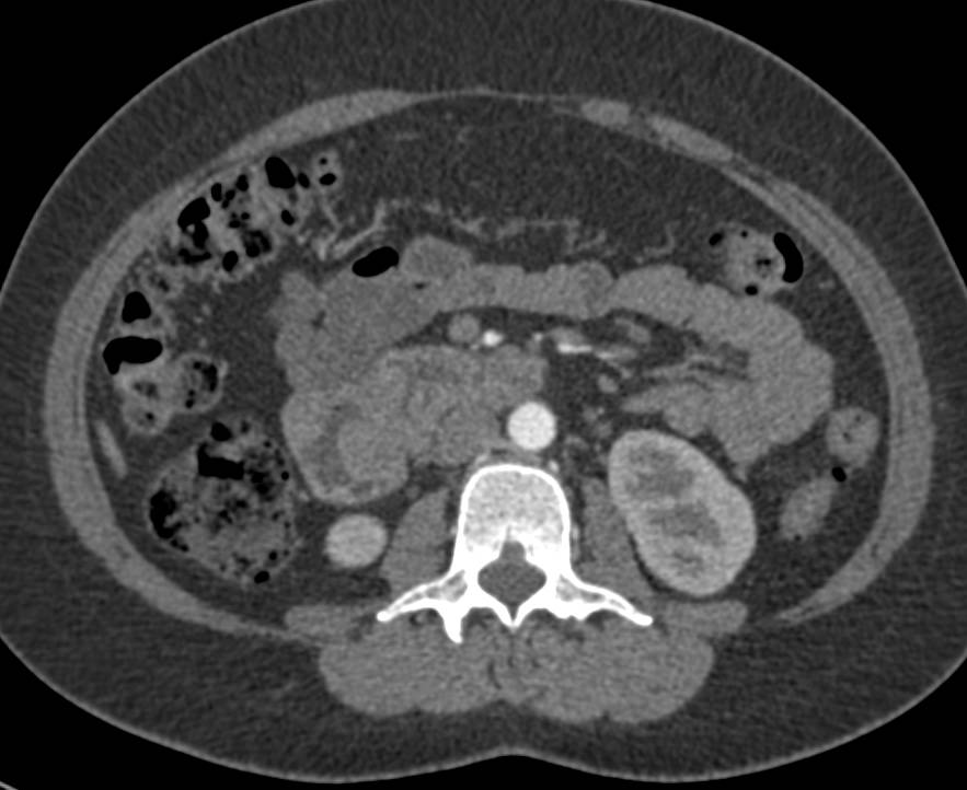 Adenocarcinoma of the Duodenum - CTisus CT Scan