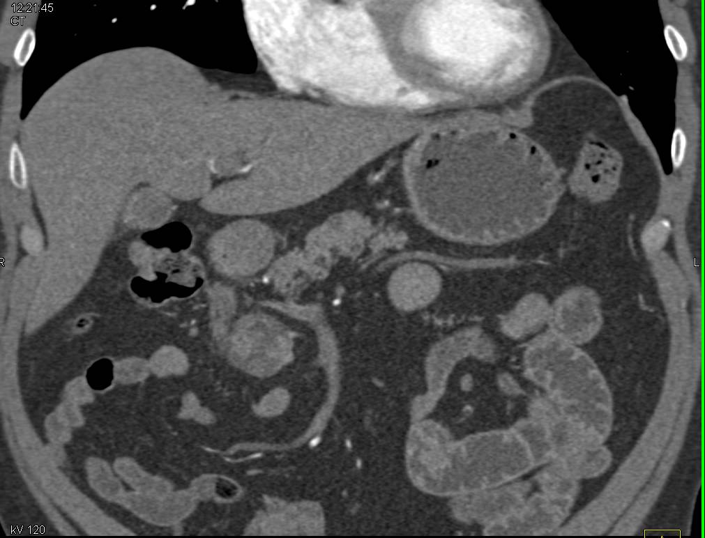 Villous Adenoma Duodenum with Dysplasia - CTisus CT Scan