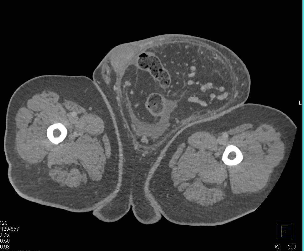 Large Inguinal Hernia with Incarcerated Bowel Into Scrotum - CTisus CT Scan