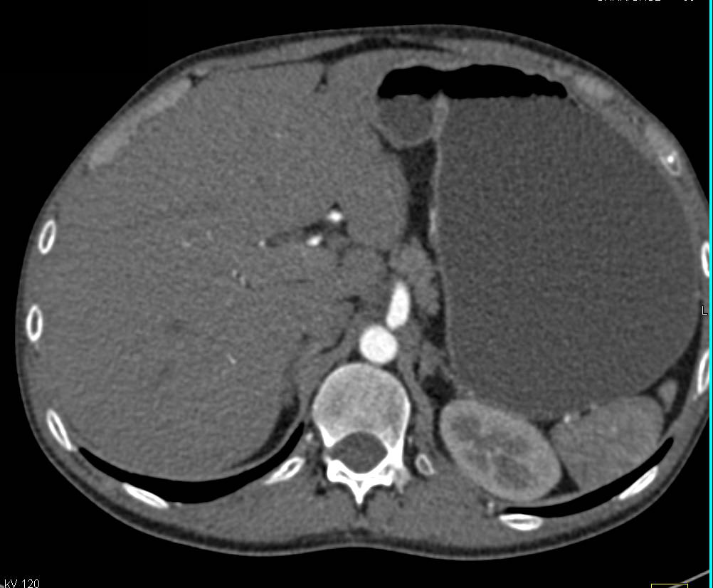 Crohn's Disease with Thickened Ileum and Prominent Vasa Recta with Collaterals - CTisus CT Scan