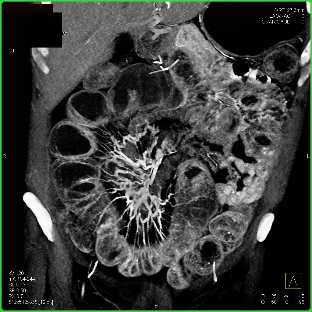 Crohn's Disease with Thickened Ileum and Entero-enteric Fistulae - CTisus CT Scan