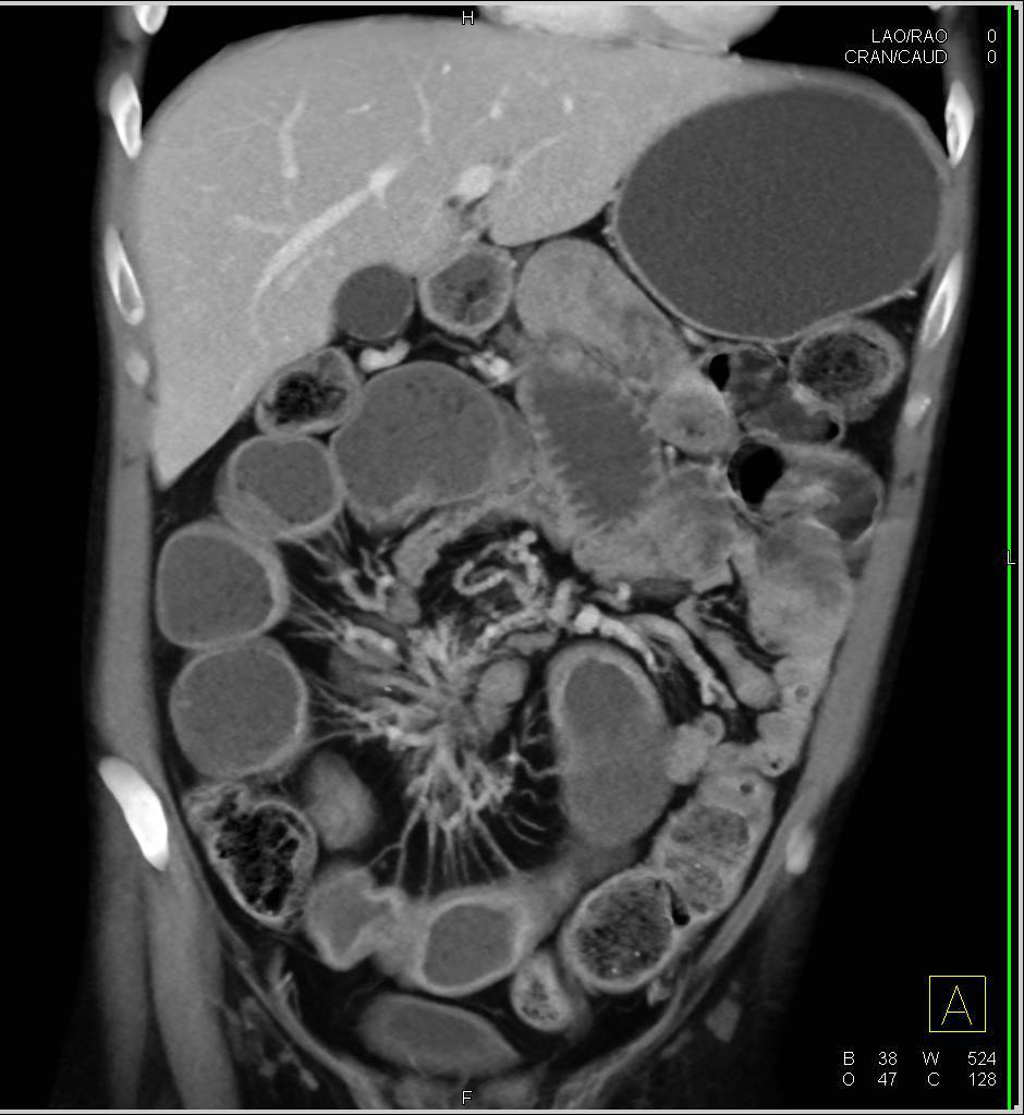 Crohn's Disease with Thickened Ileum and Strictures - CTisus CT Scan