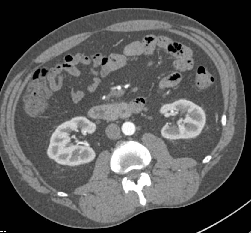 Duodenitis - CTisus CT Scan