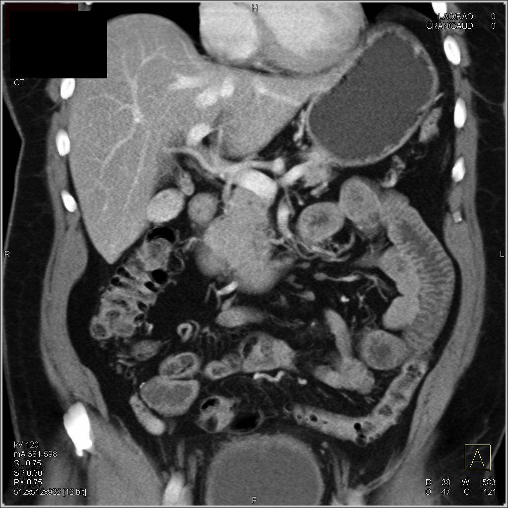 Carcinoid Tumor Near Uncinate Process - CTisus CT Scan