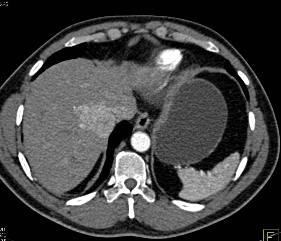 Duodenal Adenocarcinoma with Stent in Duodenum - CTisus CT Scan