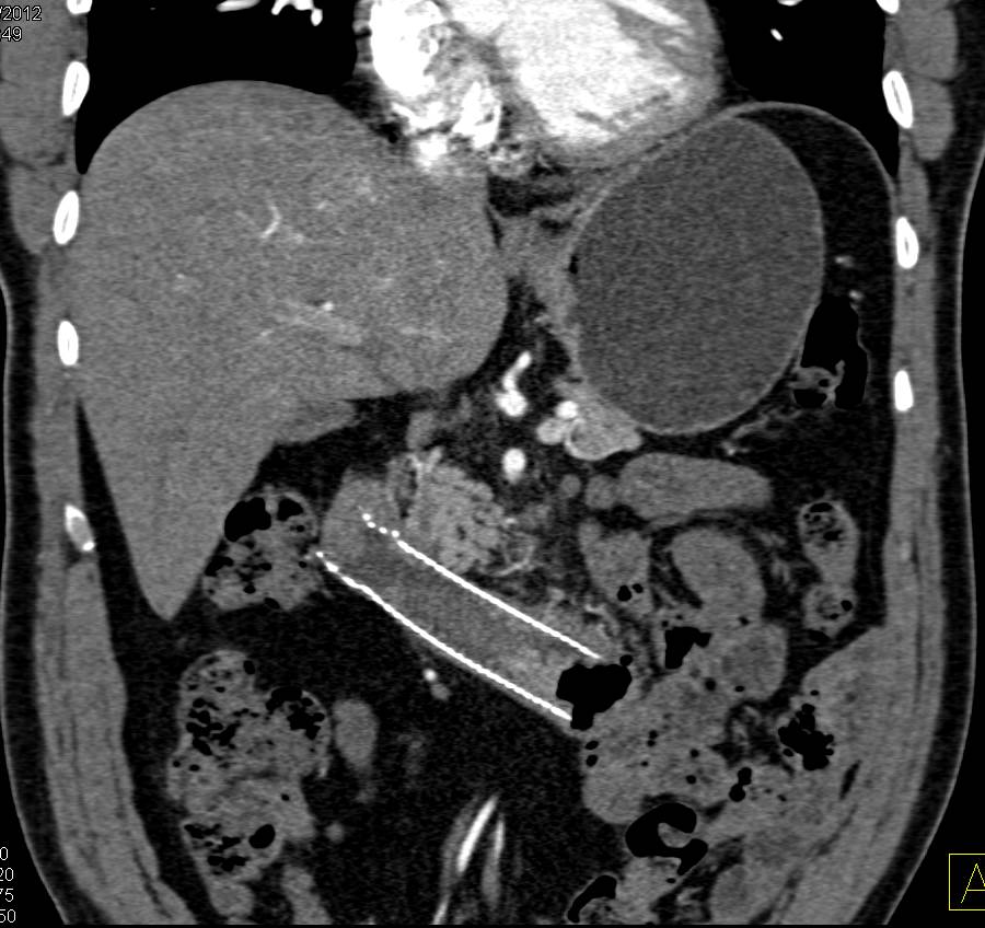 Duodenal Cancer with Stent in Third and Fourth Portion of the Duodenum - CTisus CT Scan