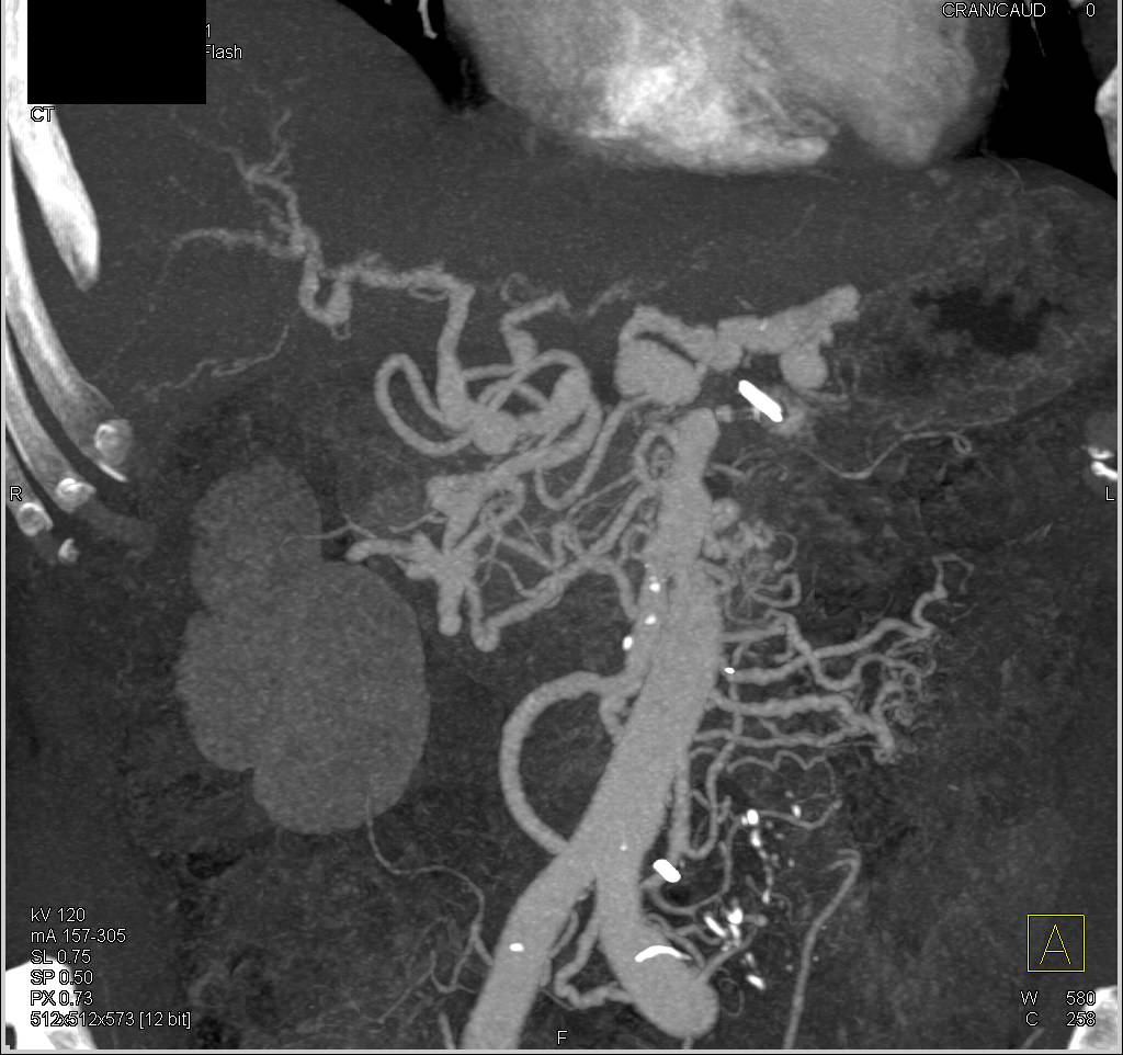 Vasculitis with Multiple Aneurysms of Superior Mesenteric Artery (SMA) and Celiac Arteries - CTisus CT Scan