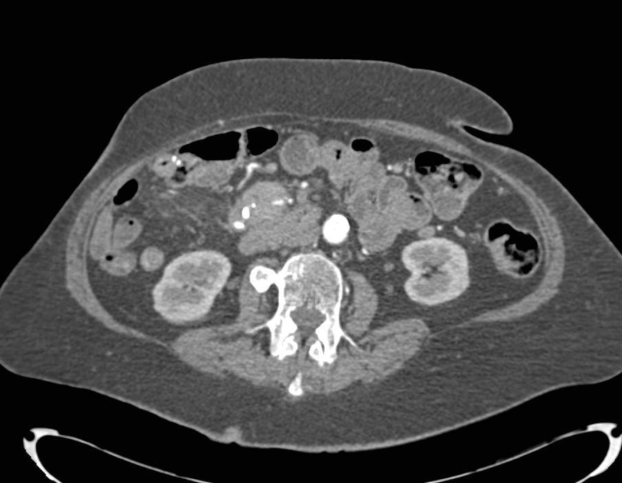 Carcinoid Tumor with Superior Mesenteric Artery (SMA) and Superior Mesenteric Vein (SMV) Involvement Simulates a Pancreatic Uncinate Mass - CTisus CT Scan