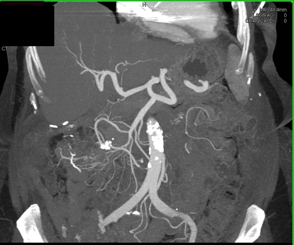 Carcinoid Tumor in Root of Mesentery is Partially Calcified - CTisus CT Scan