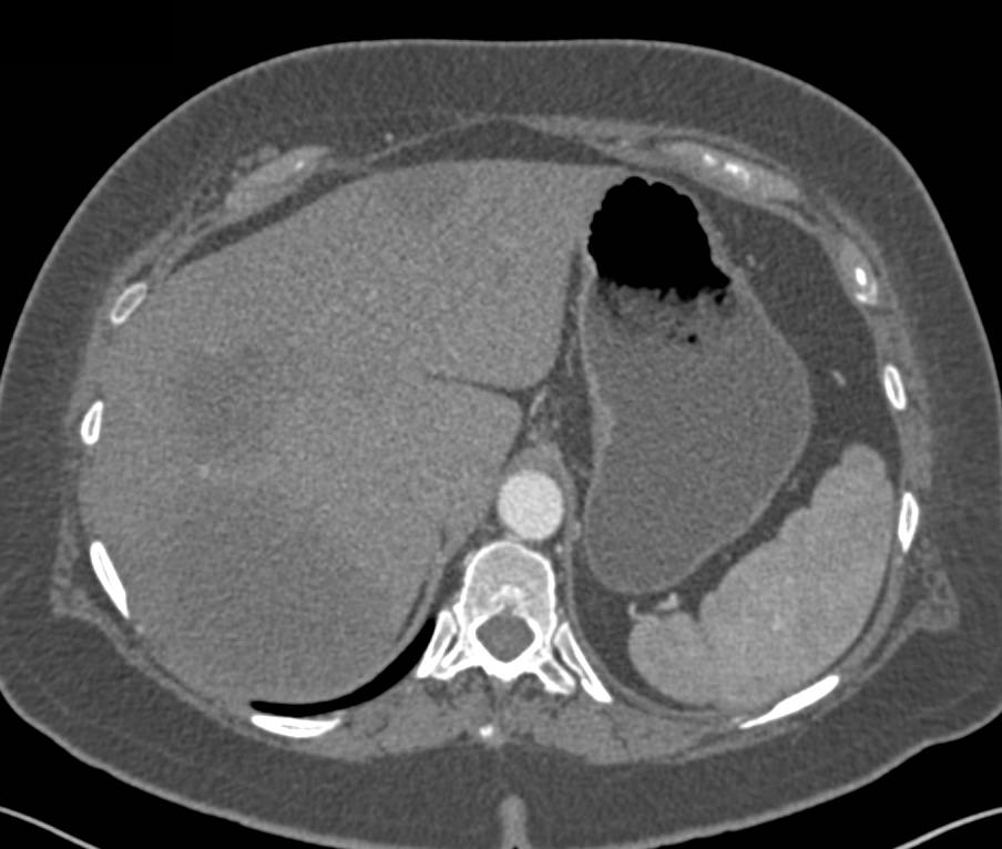 Carcinoid Tumor with Liver Metastases - CTisus CT Scan