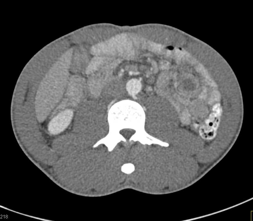 Incidental Intussusception Left Upper Quadrant - CTisus CT Scan