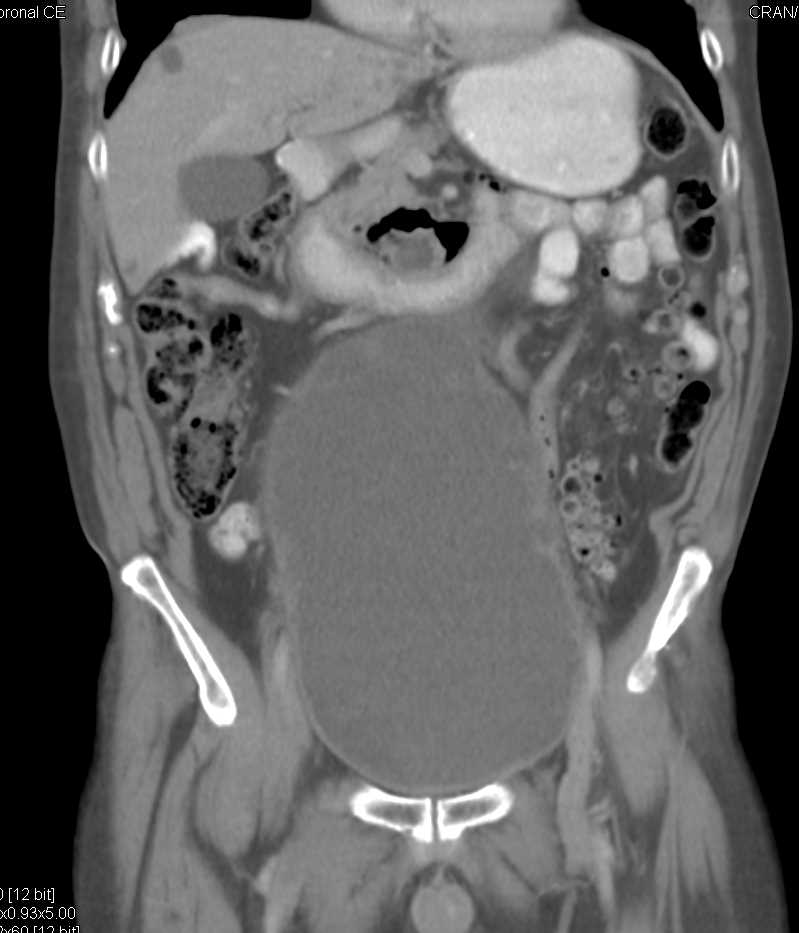 Duodenal Perforation with Free Air Following Endoscopic Retrograde Cholangiopancreatography (ERCP) - CTisus CT Scan