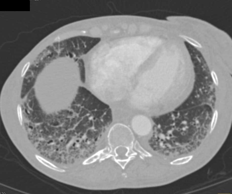 Scleroderma with Dilated Small Bowel - CTisus CT Scan