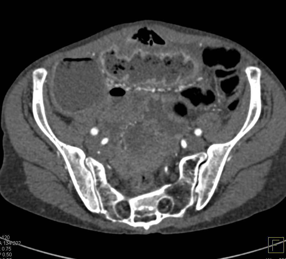 Dilated Small Bowel due to Enteritis - CTisus CT Scan