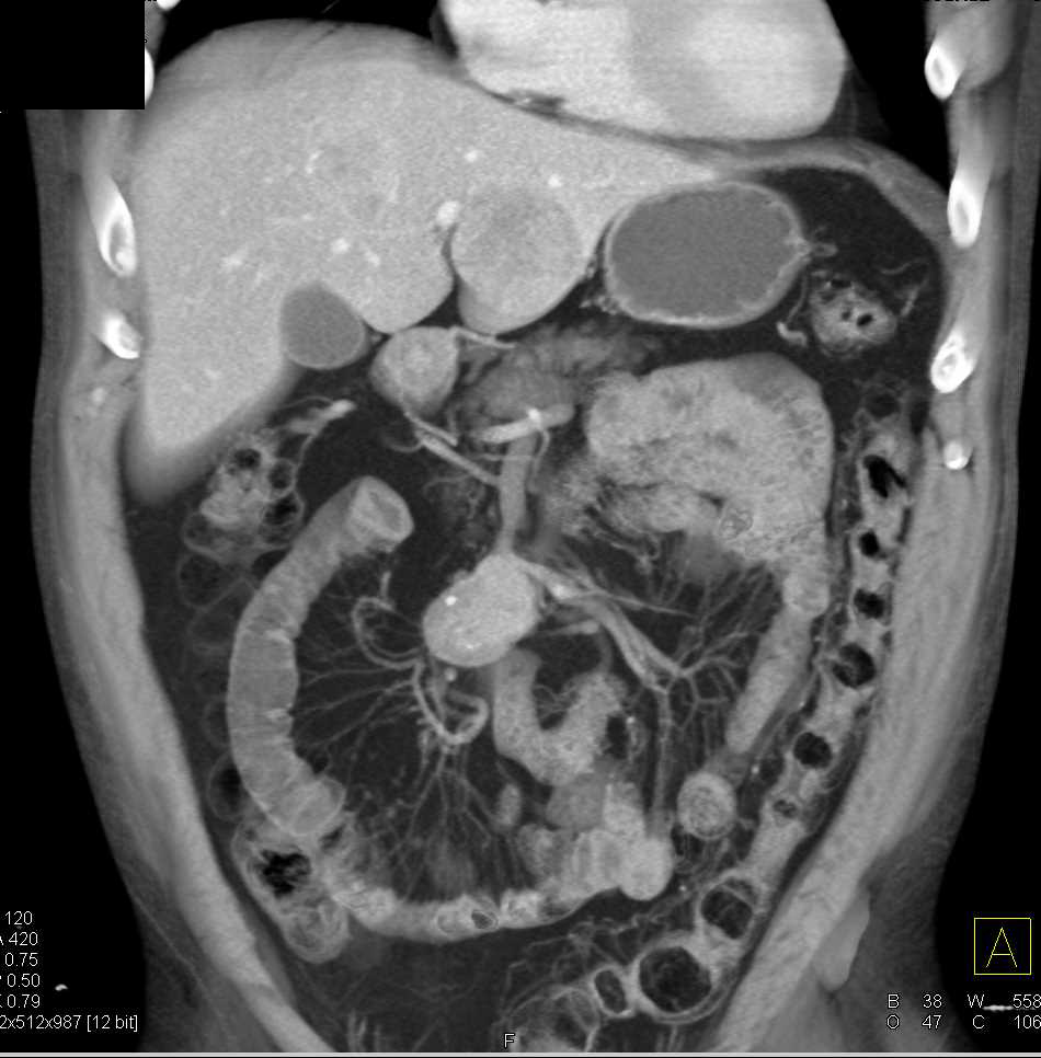 Carcinoid Tumor with Liver Metastases - CTisus CT Scan