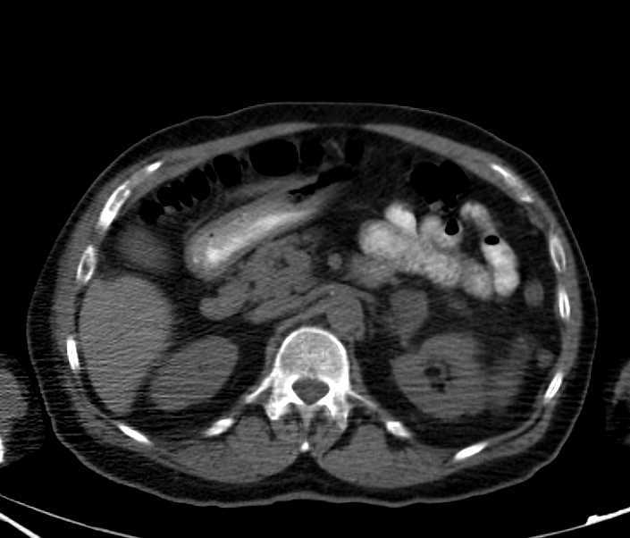 1 CM Duodenal Carcinoid Tumor - CTisus CT Scan