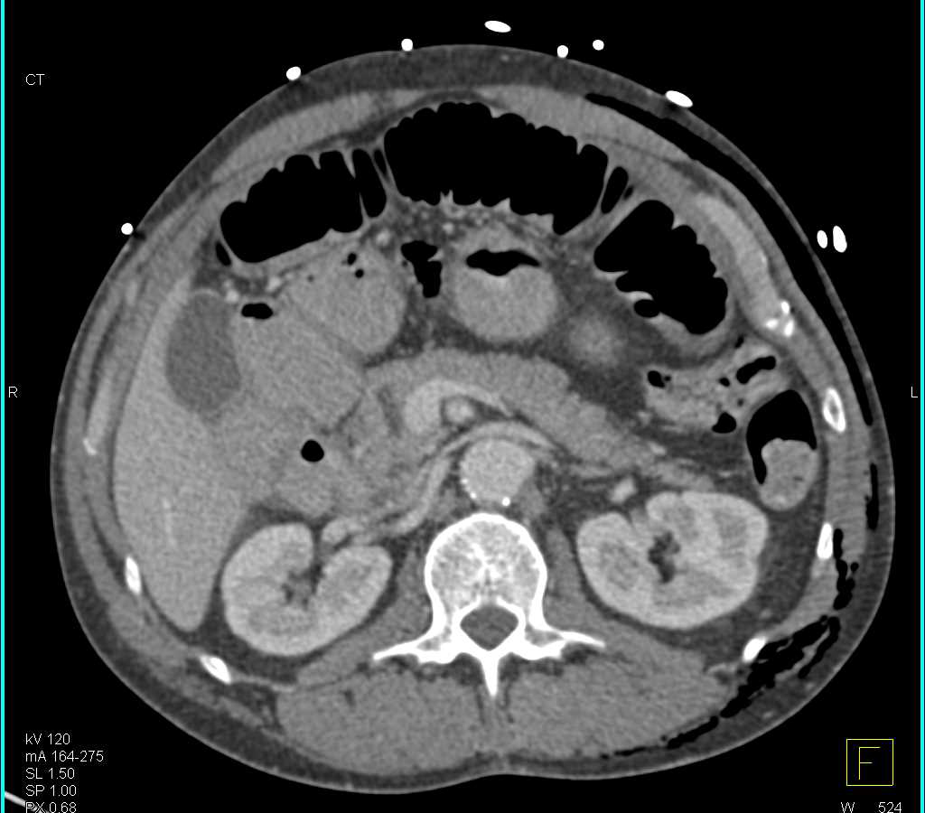 Dilated Small Bowel due to Hernia into Scrotum - CTisus CT Scan