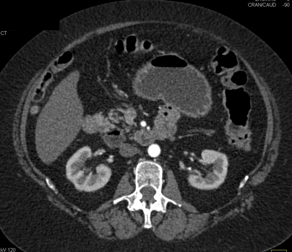 Bilobed Duodenal Diverticulum - CTisus CT Scan