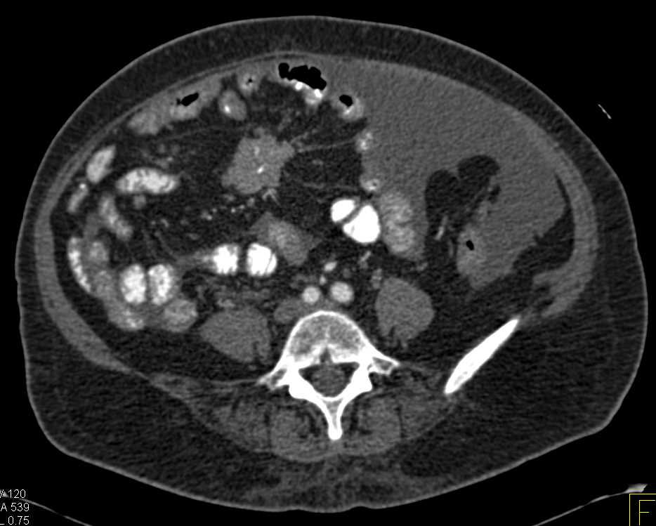 Carcinoid Tumor in Root of Mesentery - CTisus CT Scan