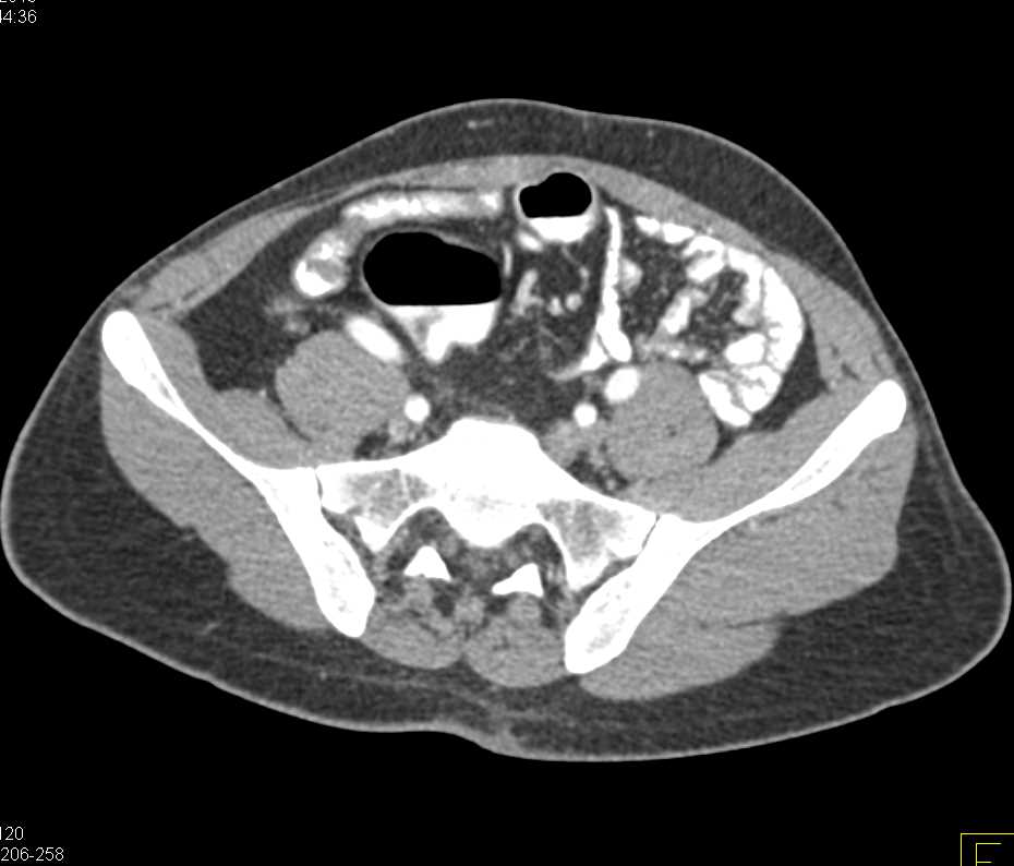 Small Bowel Opacified with Positive Contrast and Small Mesenteric Nodes - CTisus CT Scan