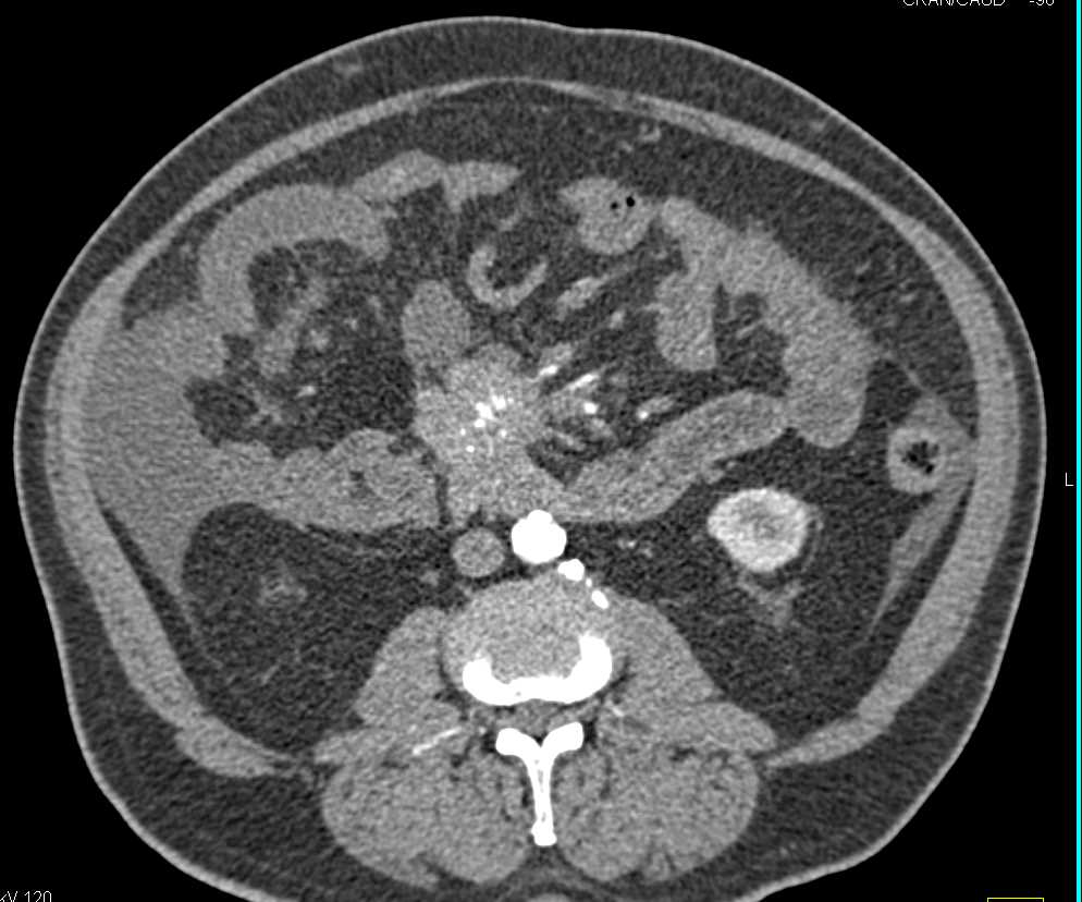 Carcinoid Tumor in the Root of the Mesentery Involves the Superior Mesenteric Artery (SMA) and Superior Mesenteric Vein (SMV) - CTisus CT Scan