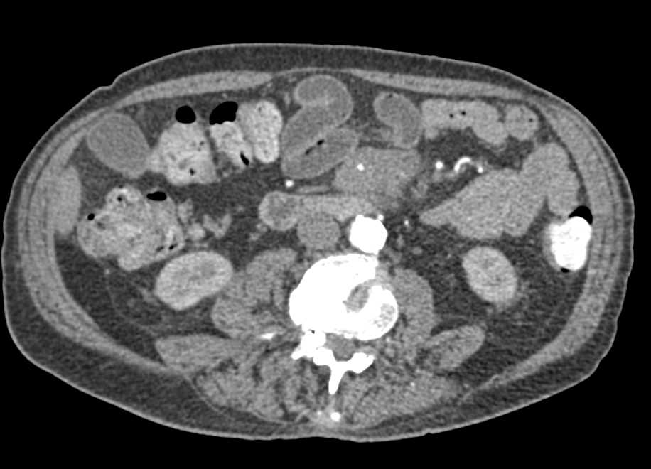 Carcinoid Tumor in Root of Mesentery Encases the Superior Mesenteric Vein (SMV) Branches - CTisus CT Scan