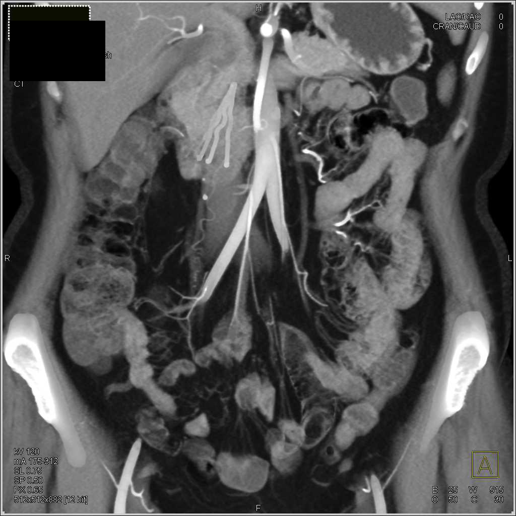 Colitis with Crohn's Disease - CTisus CT Scan