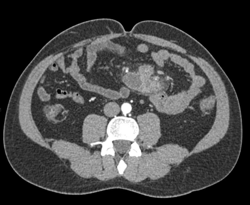 Mycobacterium avium/intracellulare (MAI) with Necrotic Nodes in the Mesentery - CTisus CT Scan