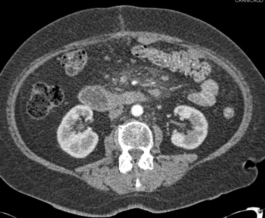 Carcinoma of the 3rd Portion of the Duodenum - CTisus CT Scan