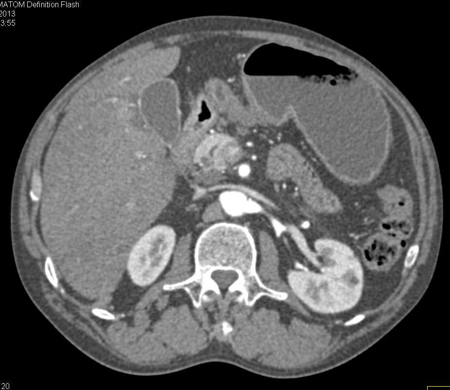 Carcinoid Tumor in the Duodenum - CTisus CT Scan