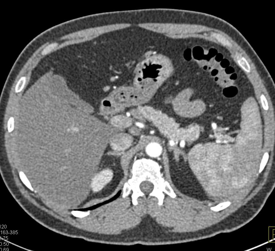 Crohn's Disease with Prominent Vasa Recta and Comb Sign - CTisus CT Scan