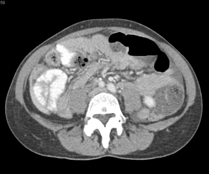 Small Bowel Obstruction (SBO) with Feces Sign - CTisus CT Scan