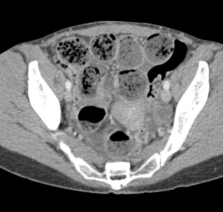 Small Bowel Obstruction (SBO) with Feces Sign due to Adhesions - CTisus CT Scan