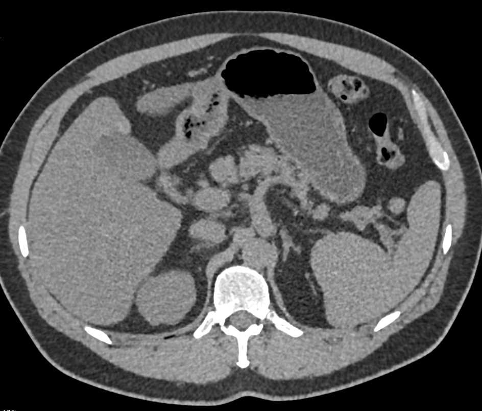 Ehlers-Danlos Syndrome with Involvement of the Mesenteric Arteries with Superior Mesenteric Artery (SMA) Dissections and Beading - CTisus CT Scan