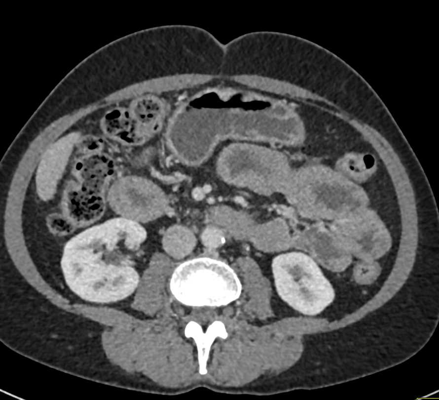 Thickened Small Bowel Loops C/W Sprue - CTisus CT Scan