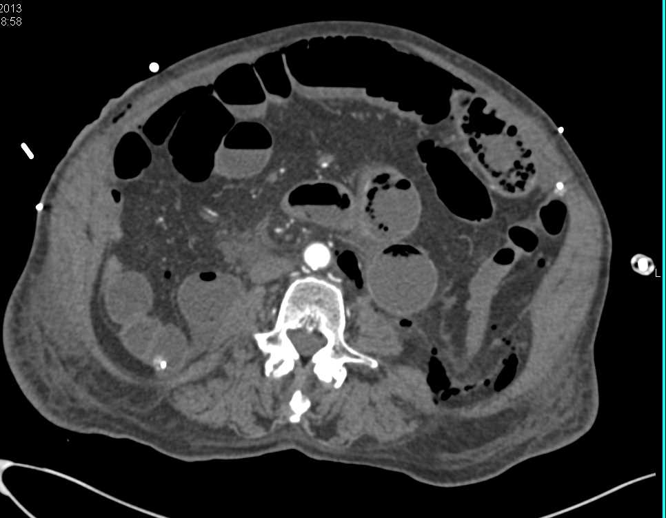 Ischemic Bowel with Pneumatosis Develops - CTisus CT Scan