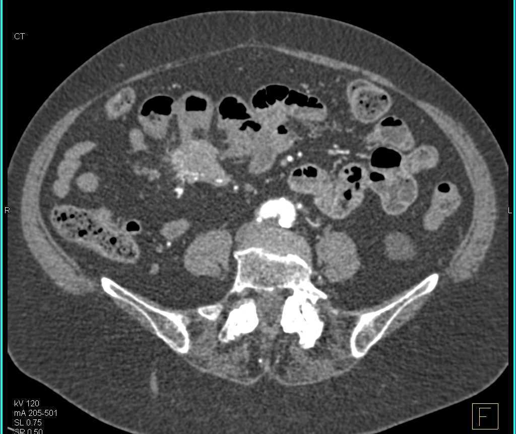 Carcinoid Tumor Root of Mesentery with Desmoplastic Reaction - CTisus CT Scan