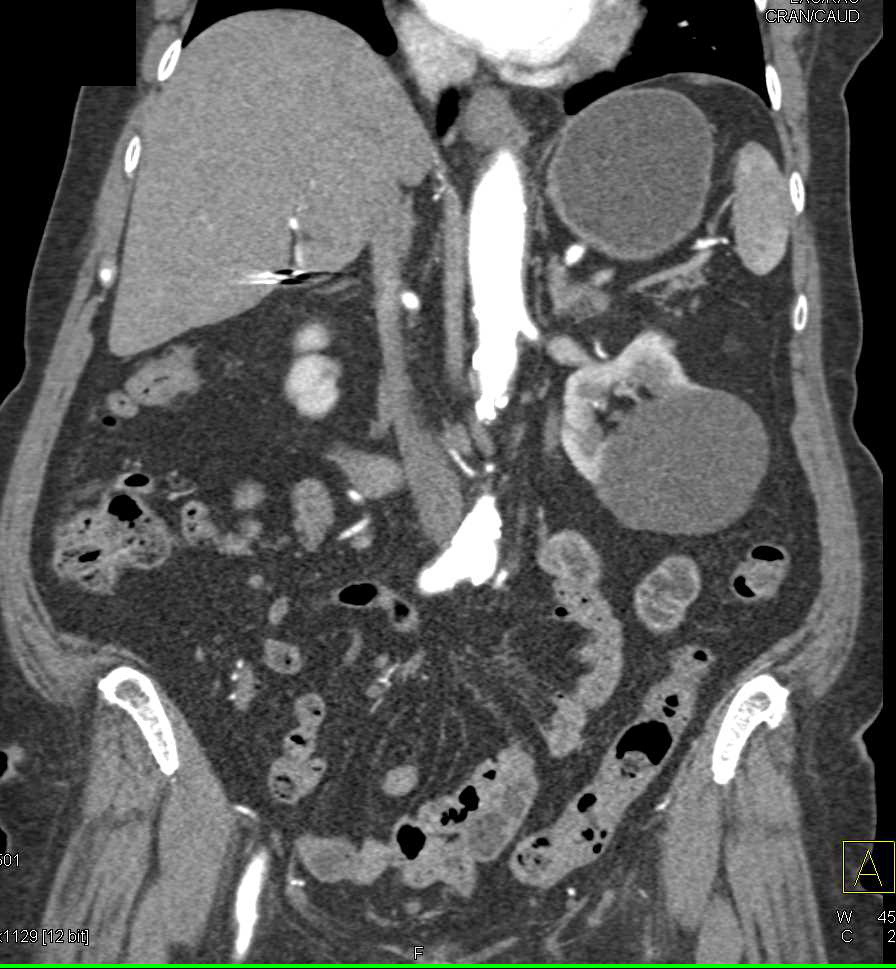 Carcinoid Tumor in RLQ with Liver Metastases - CTisus CT Scan