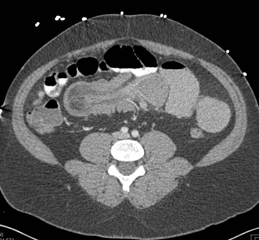 Lipoma Causing a Small Bowel Intussusception - CTisus CT Scan