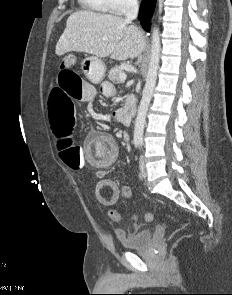 Lipoma Causing a Small Bowel Intussusception - CTisus CT Scan