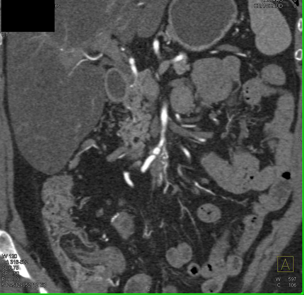 Carcinoid Tumor in Mesentery Encases the Superior Mesenteric Artery (SMA) and Superior Mesenteric Vein (SMV) - CTisus CT Scan