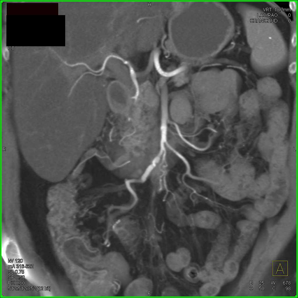 carcinoid-tumor-in-mesentery-encases-the-superior-mesenteric-artery