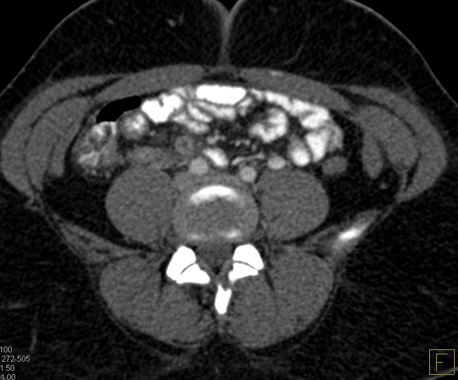 Infectious Enteritis Distal Small Bowel - CTisus CT Scan