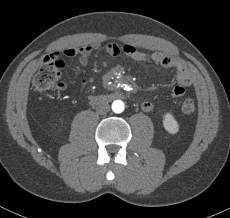 Sclerosing Mesenteritis - CTisus CT Scan