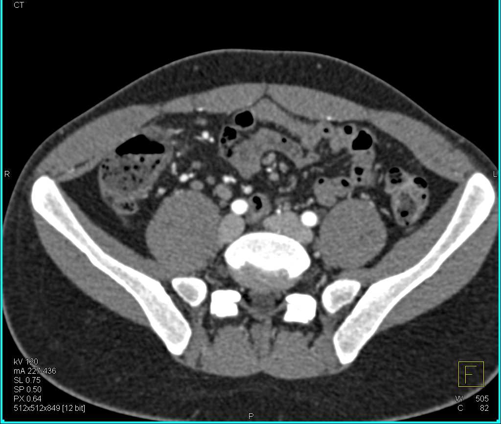 Crohn's Disease Involves the Ileum and Cecum - CTisus CT Scan