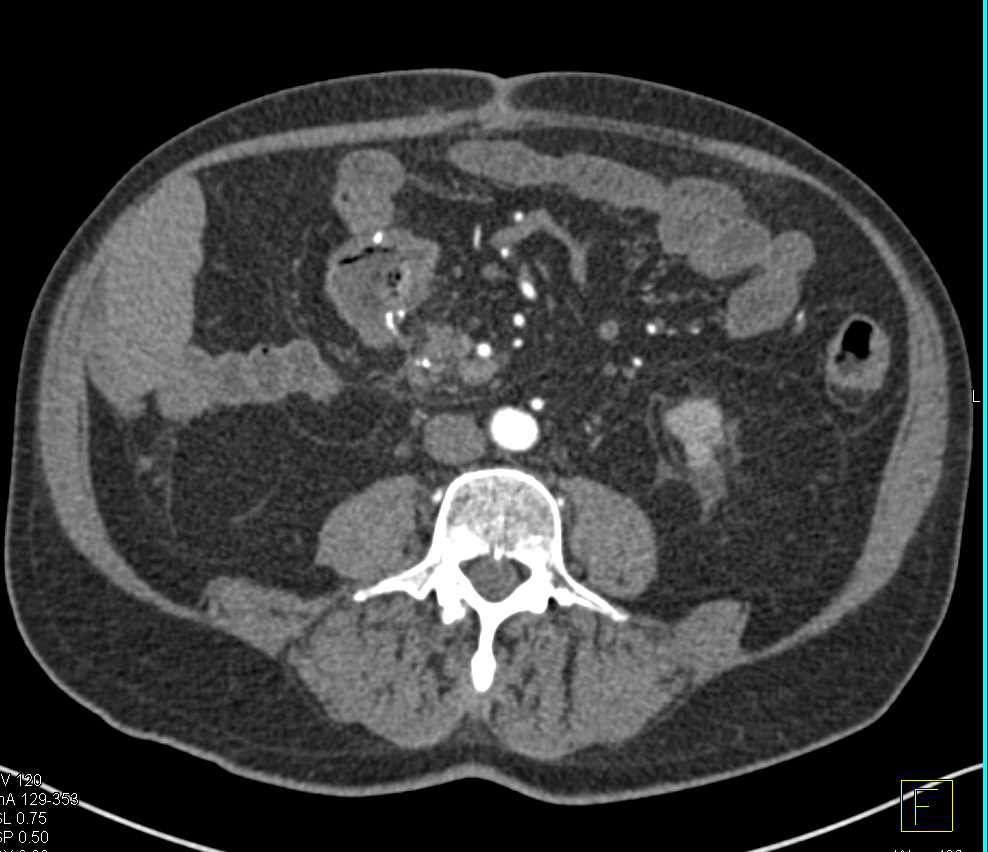 Carcinoid Tumor with Superior Mesenteric Vein (SMV) Clot and Mesenteric Mass - CTisus CT Scan