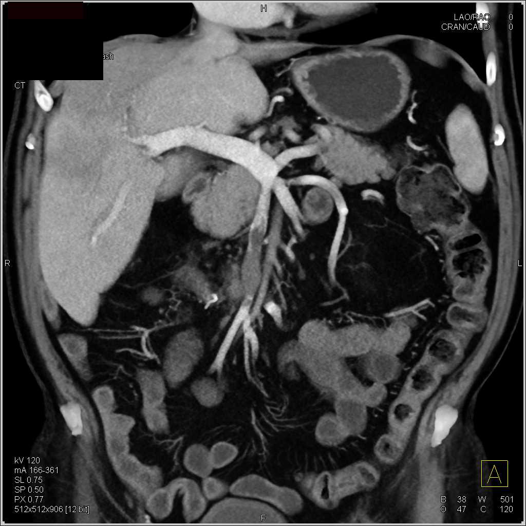 Carcinoid Tumor with Superior Mesenteric Vein (SMV) Clot and Mesenteric Mass - CTisus CT Scan