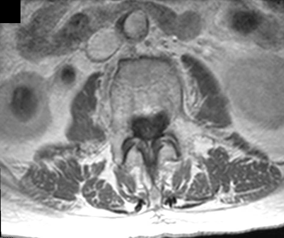 Small Bowel Lipoma - CTisus CT Scan