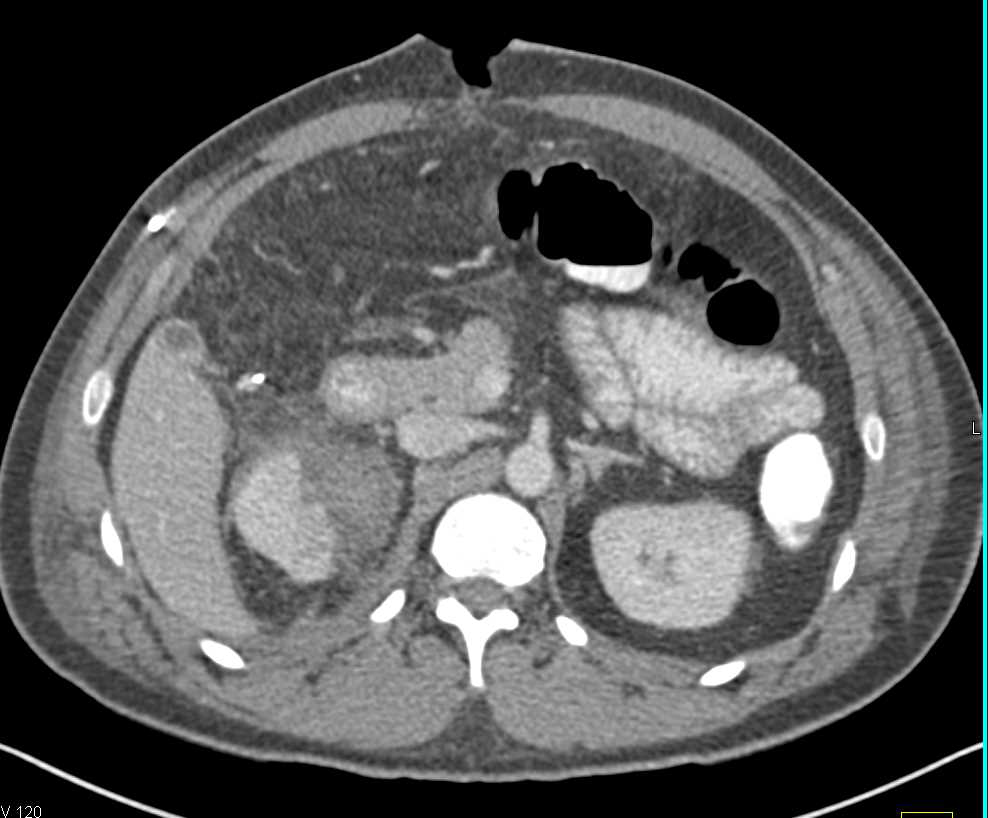 Edematous Small Bowel and Peritonitis in a Post-Op Patient - CTisus CT Scan