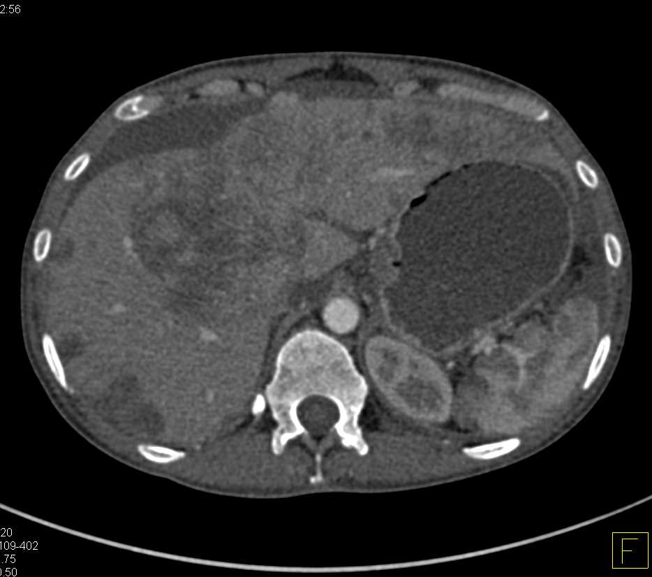 Synovial Sarcoma Metastatic to the Small Bowel with Intussusceptions - CTisus CT Scan